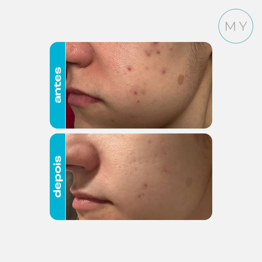 Esfoliante Químico Ácido Glicólico 30g - Creamy